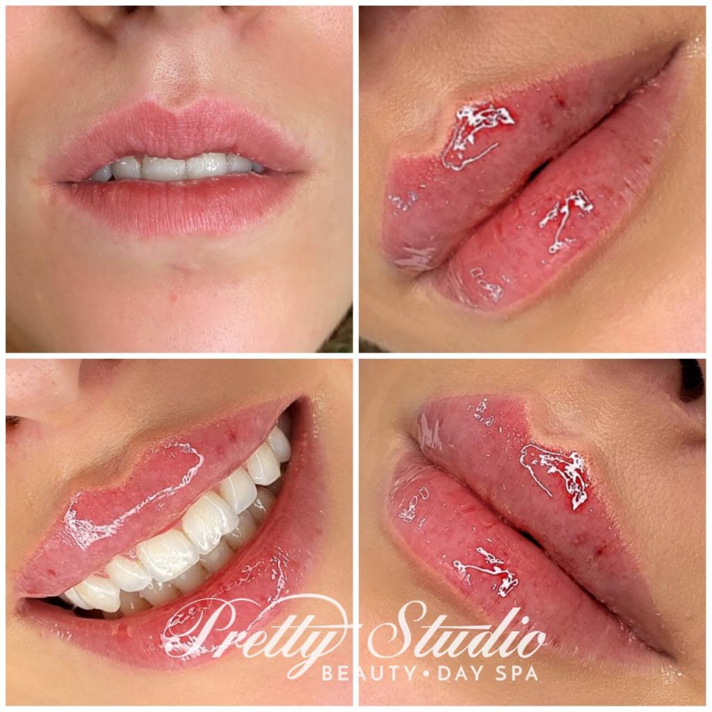 Baby Doll Lips Powiekszanie Ust Powiększanie ust metodą Baby Doll Lips | Pretty Studio - Beauty & Day SPA