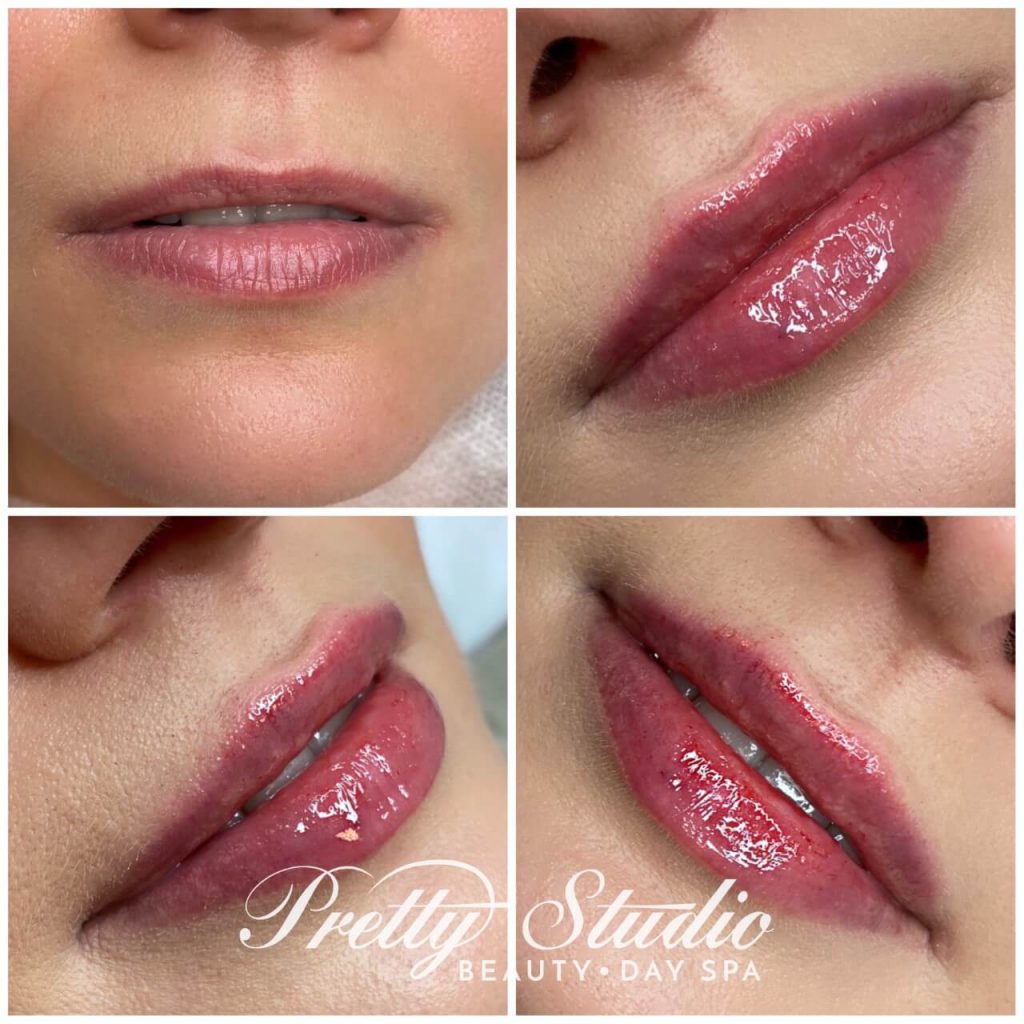 Baby Doll Lips Powiekszanie Ust Powiększanie ust metodą Baby Doll Lips | Pretty Studio - Beauty & Day SPA